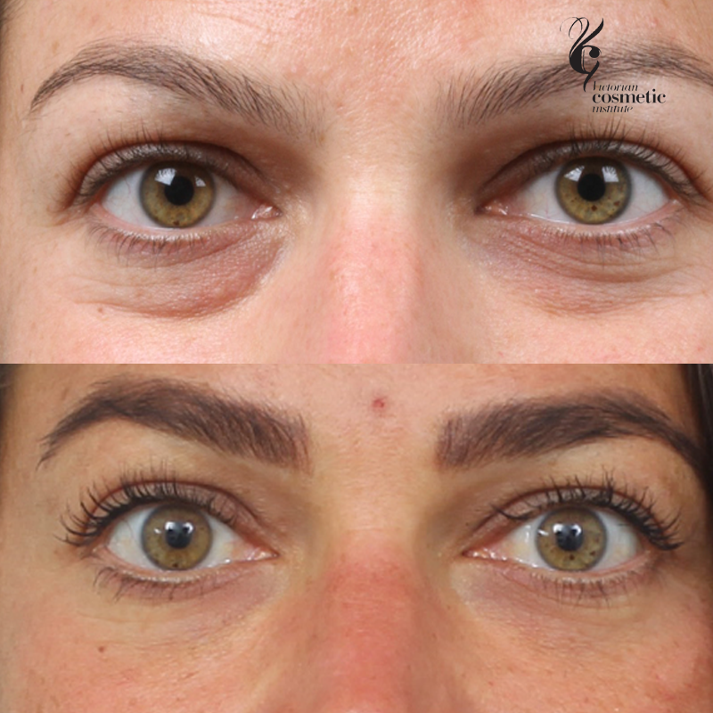 Bags Under Eyes Treatment Fillers | Jaguar Clubs of North America