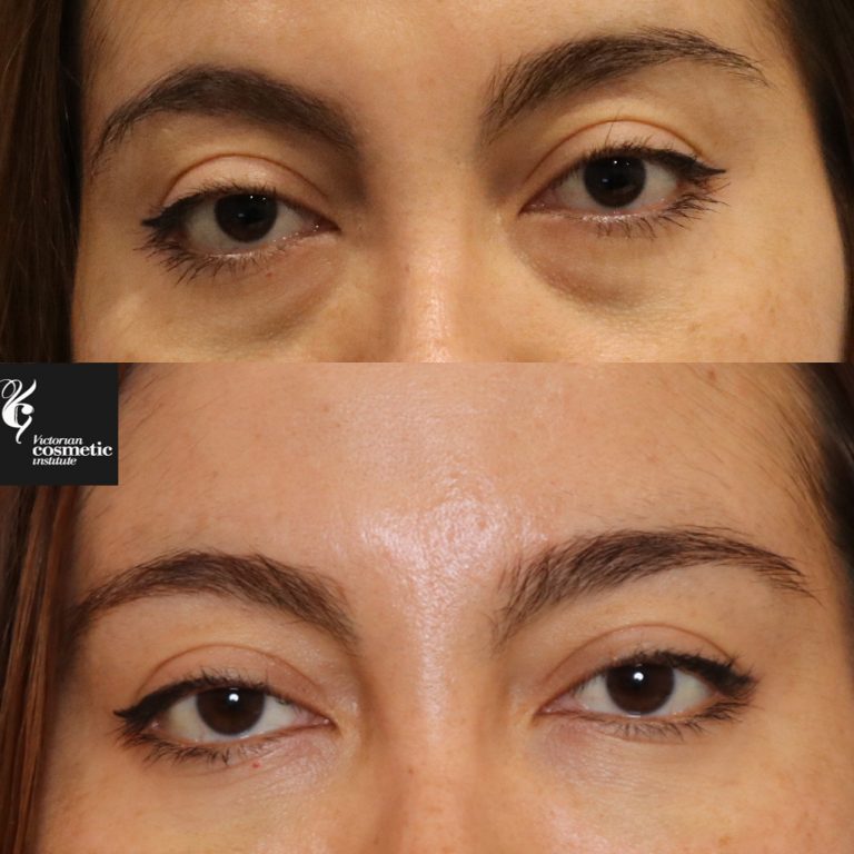 Non-surgical Tear Trough or Eye Bag & Under Eye Filler Treatments Melbourne