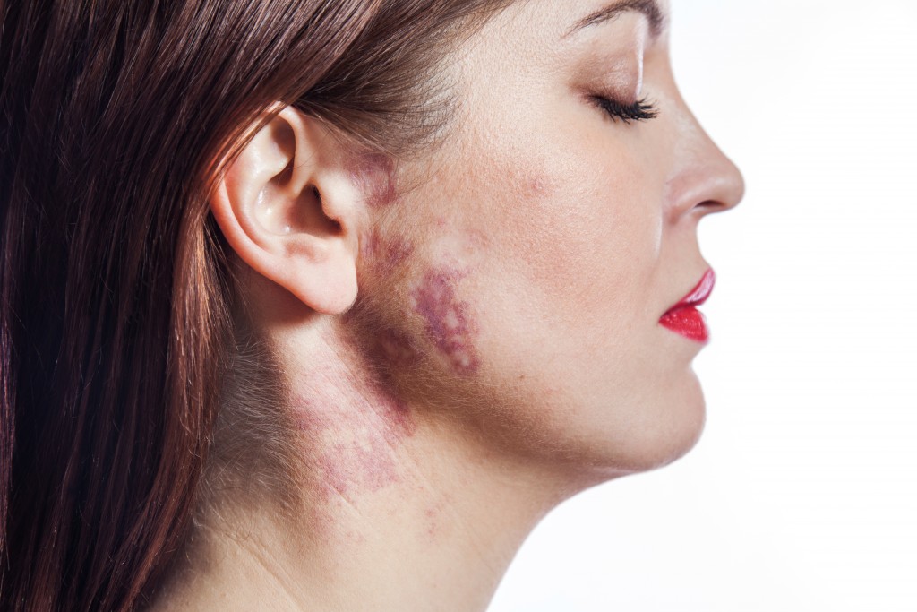 birthmark-removal-melbourne-port-wine-stains