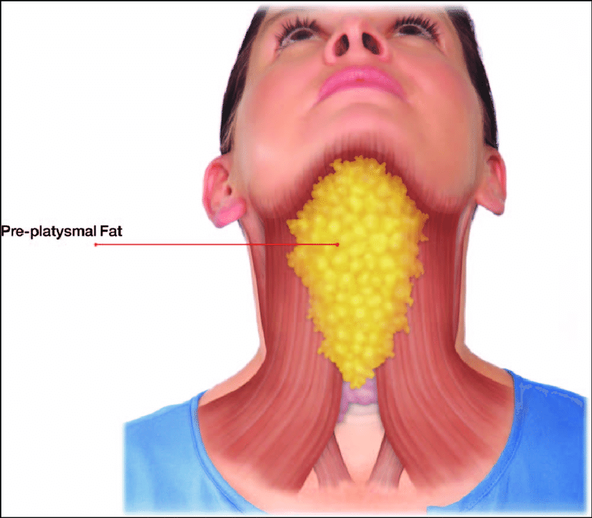 How To Get Rid Of Double Chin Without Surgery The Victorian Cosmetic 