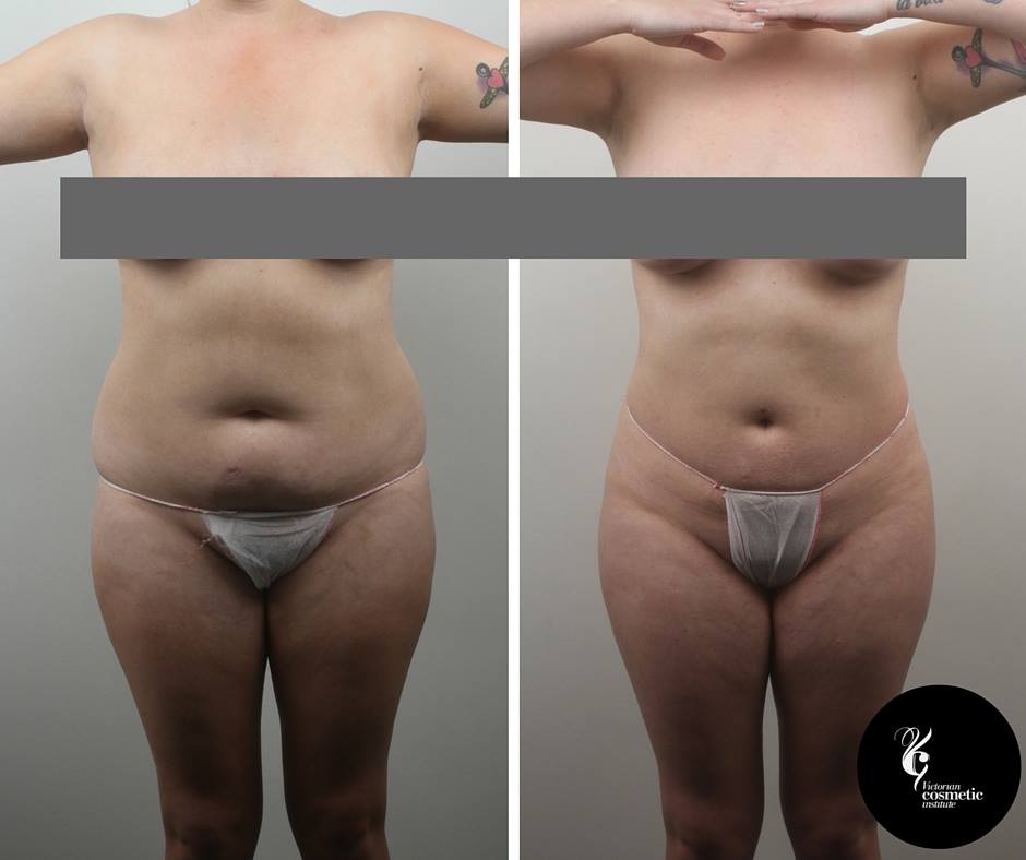 Plastic Surgery Case Study - Large Abdominal Panniculectomy in a Male  Weight Loss Patient - Explore Plastic Surgery