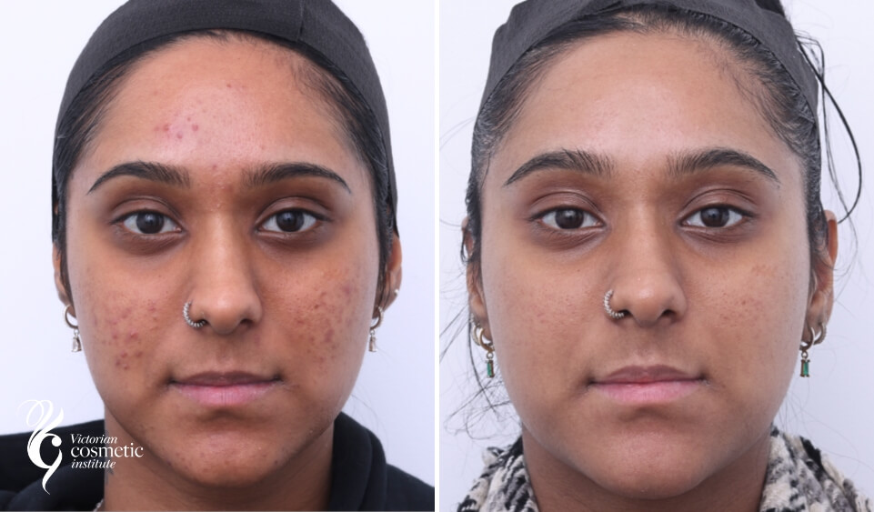 acne treatment before and after chemical peels