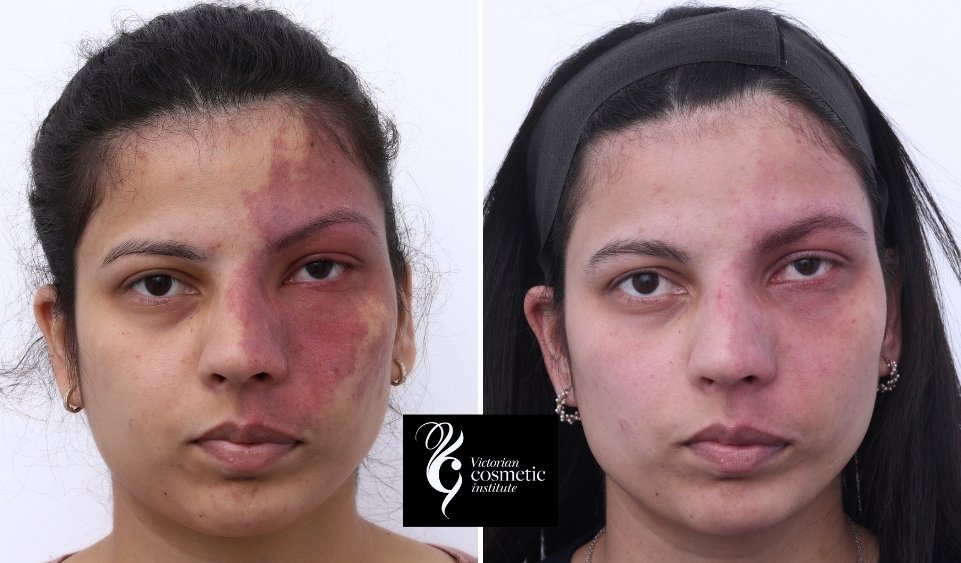 port wine stain before and after laser treatment