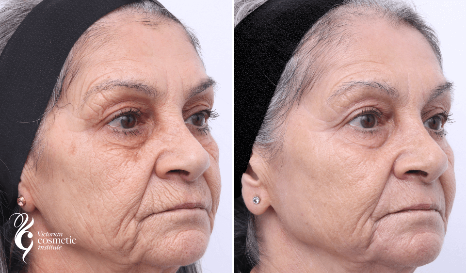 Co2 laser skin resurfacing melbourne before and after