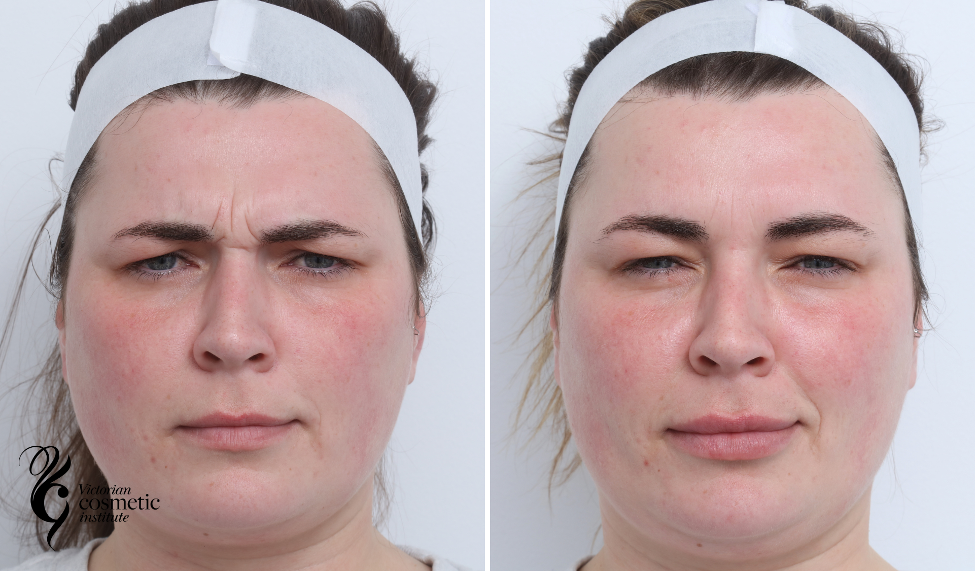 Anti Wrinkle Injection Clinic Melbourne, Victorian Cosmetic Institute