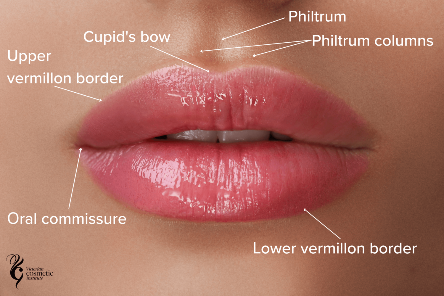 Lip Fillers Melbourne Victorian Cosmetic Institute