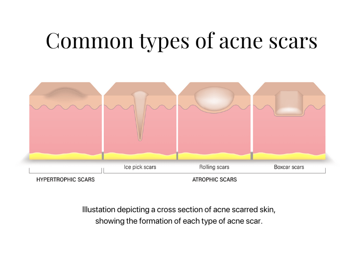 Acne Scarring Treatment Melbourne - Victorian Cosmetic Institute