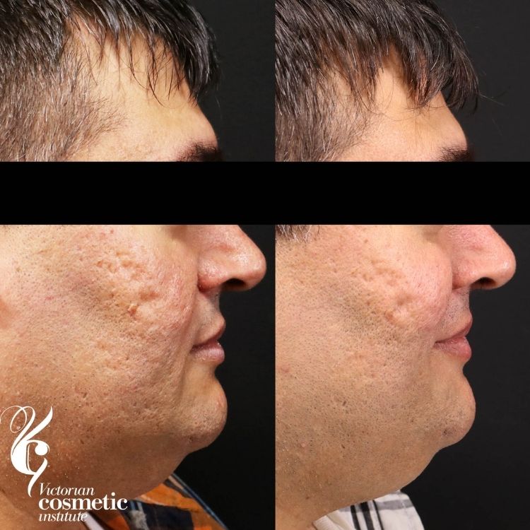 RF Needling acne scarring before and after male