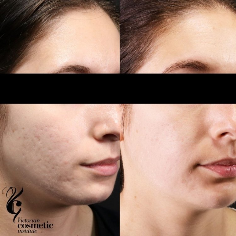 RF Needling acne scarring before and after female